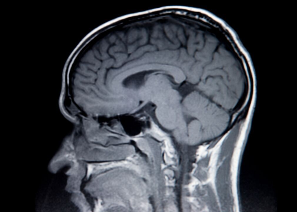 How COVID-19 affects the brain